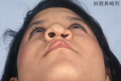 【余文林】关于唇裂继发性唇鼻畸形的修复