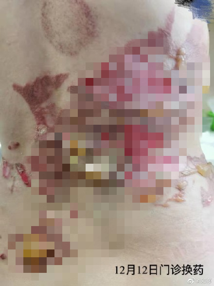 然而等过了两天她去换药,再看看那伤口:  皮肤溃烂,血肉模糊,隔着屏幕