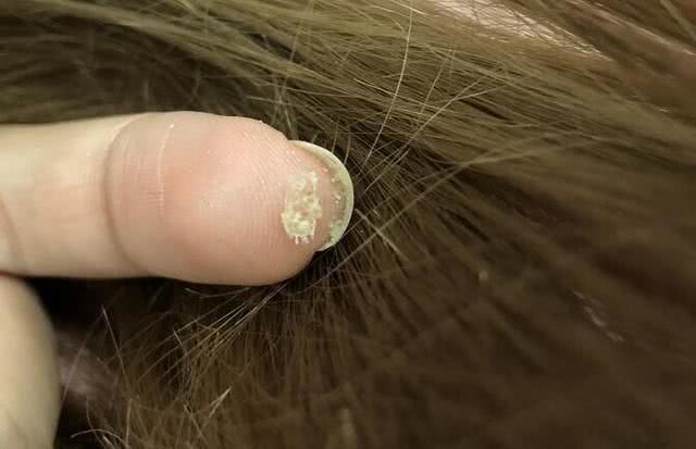 正常情况下,头皮上会出现一些灰尘,皮脂分泌物,脱落的角质和细胞,这些