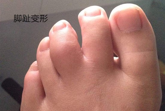 原创5岁宝宝脚趾变形只因家长总是给他穿这种鞋子别舍不得花钱