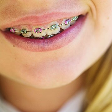 振作起来:儿童牙套的事实