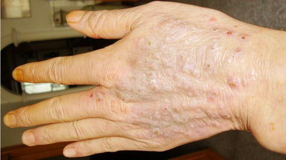 鱼鳞病患者冬季如何护理?面对冷热风的刺激当如何避免这种情况?