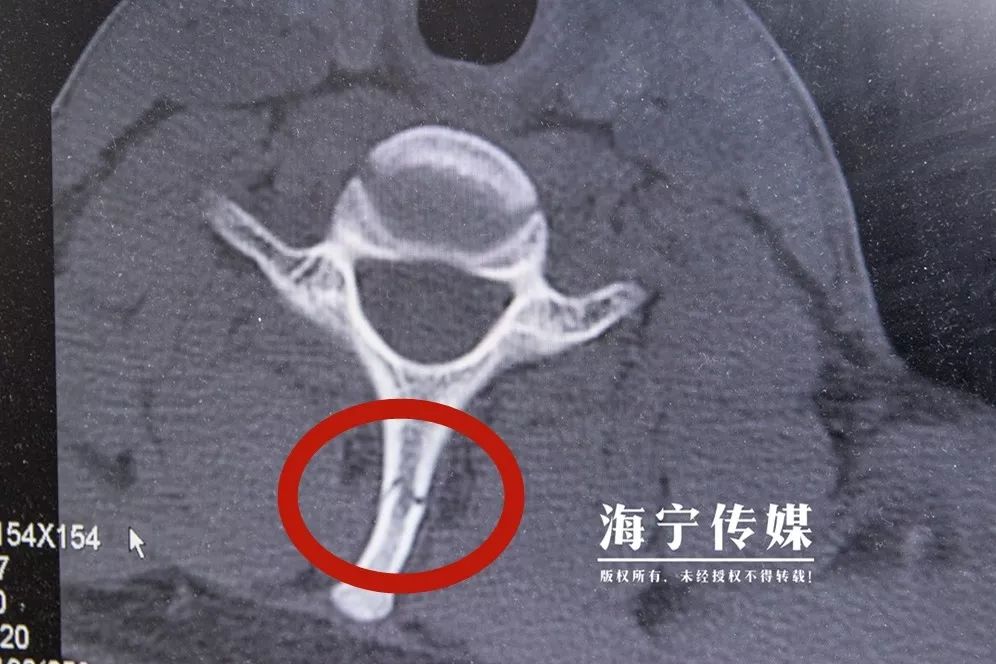 t1棘突骨折图片