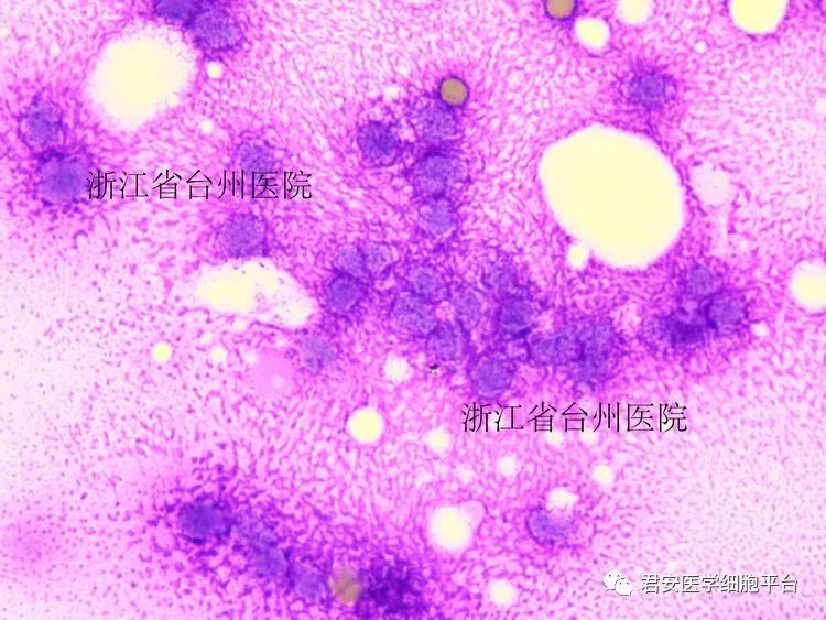 骨髓塗片腫瘤系列 乙肝檢查血常規生化患者女性,14歲.