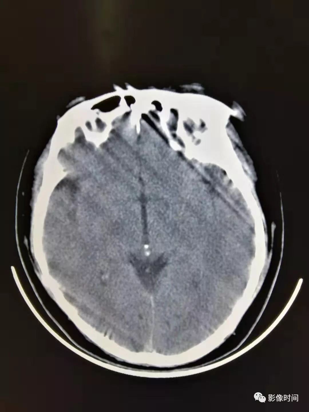 ct检查中那些您可能会忽视的伪影