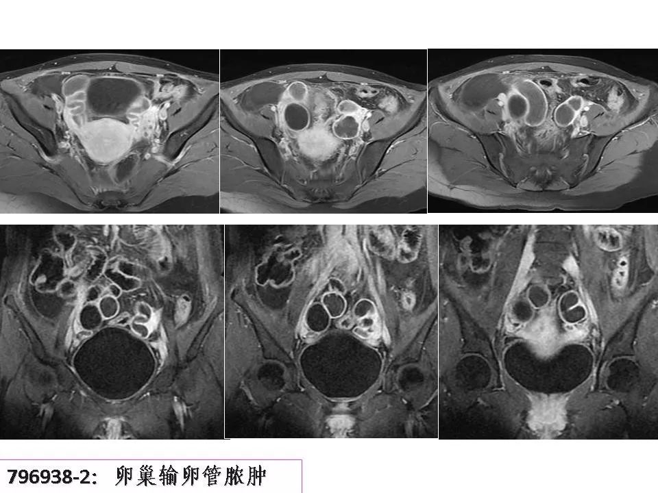 mr對卵巢病變的診斷價值
