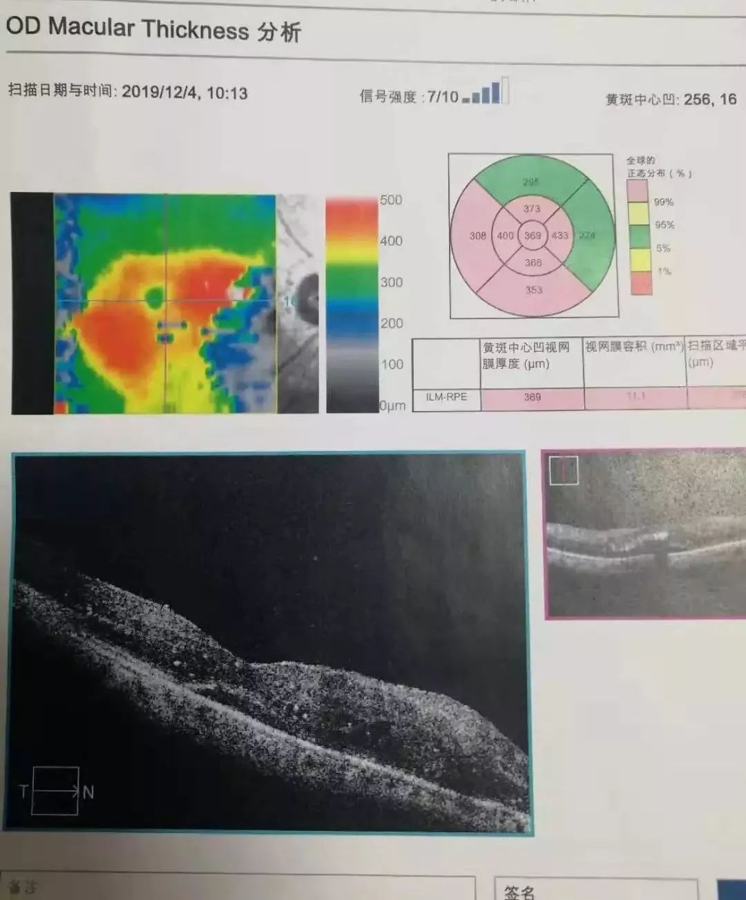 老年性黃斑水腫oct正常眼底octoct主要用於眼後段結構(包括視網膜