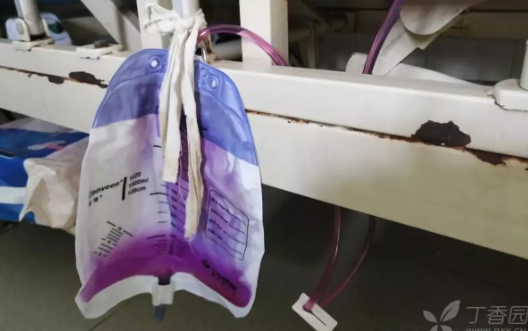 患者出现紫色尿液?这是什么情况?