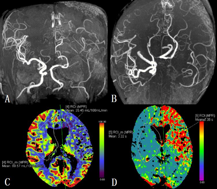 双干sta-mca搭桥治疗症状性颈内动脉闭塞一例(脑血管系列四)---浙二神