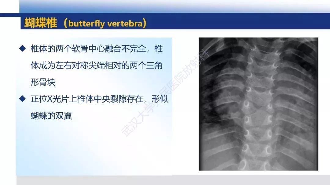 先天性椎体畸形影像诊断