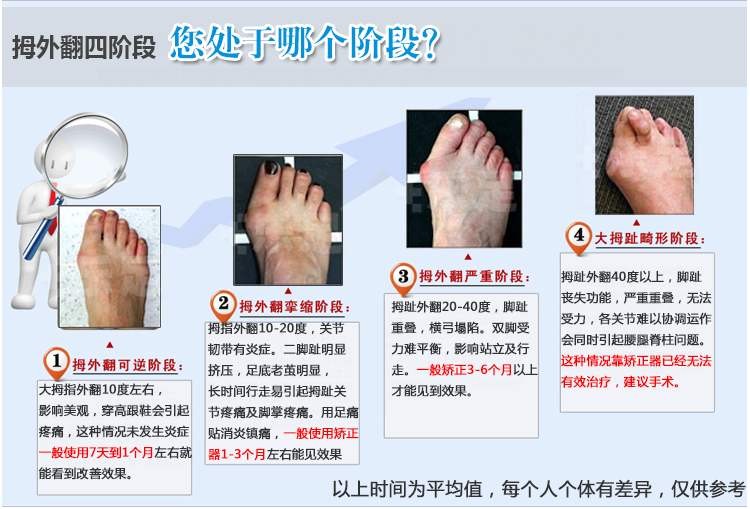 拇指外翻告别夏天