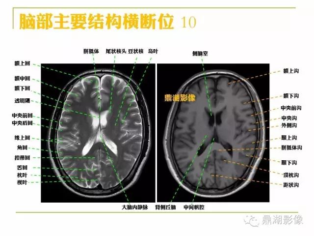 超详细头颅mr高清解剖必点收藏