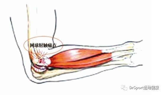 橈側腕短伸肌起點即肘關節外上髁壓痛;三,如何自查是否為網球肘症狀呢