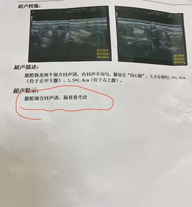 这例肠套叠病例非常不典型,从病史看,呕吐伴有腹泻,腹部超声检查2个