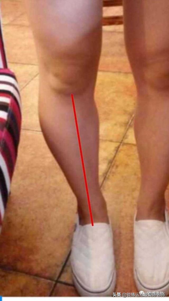 (  这里偏个题,不要给小孩子绑腿哦,这样对他发育不好,生理性弓形腿在