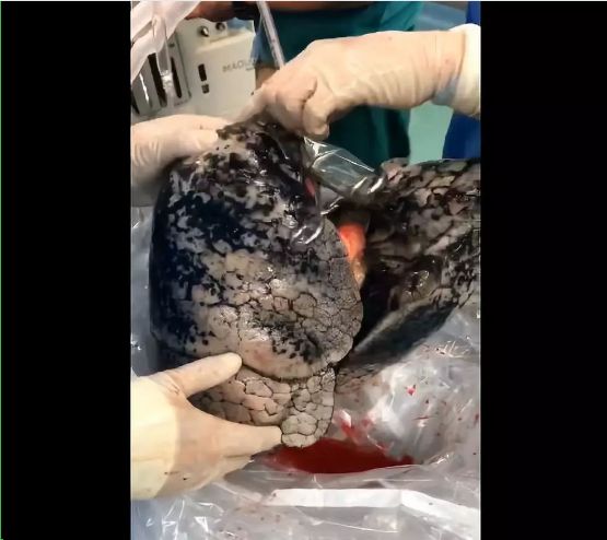 8岁女孩肺癌晚期竟是因为爸爸类似悲剧武汉重演