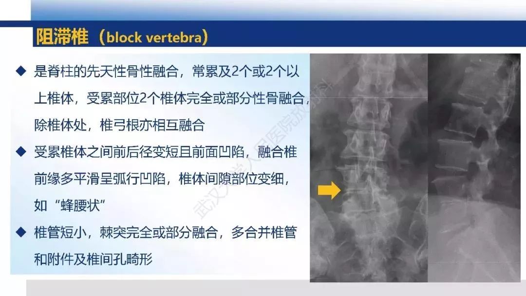 先天性椎体畸形影像诊断