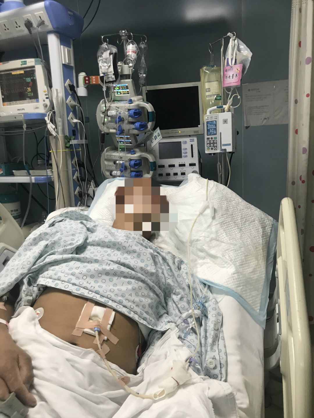 马冬璞团队和内镜中心医务人员共同为张先生进行经皮内镜胃造瘘术