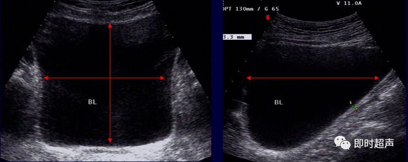 膀胱超声解剖及常见病变超声表现