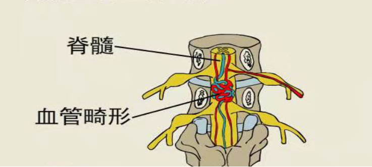 脊髓血管畸形和腰椎间盘突出的症状有哪些不同?