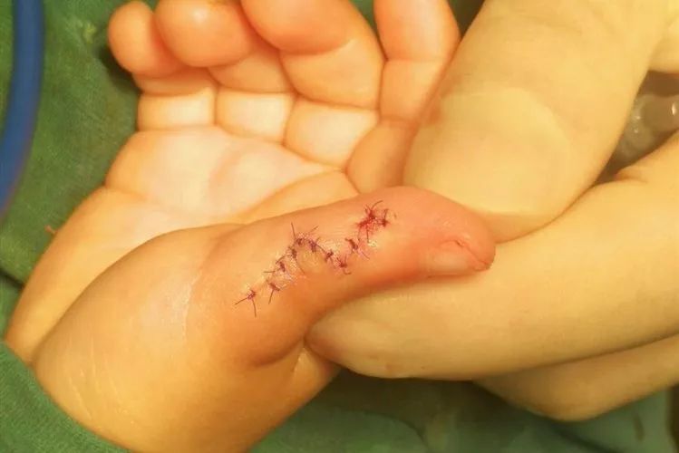 多指畸形术后荥阳市中医院外二科简介荥阳市中医院外二科下设胃肠,甲