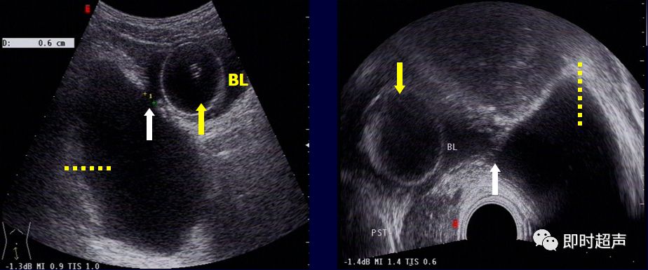 膀胱超声解剖及常见病变超声表现