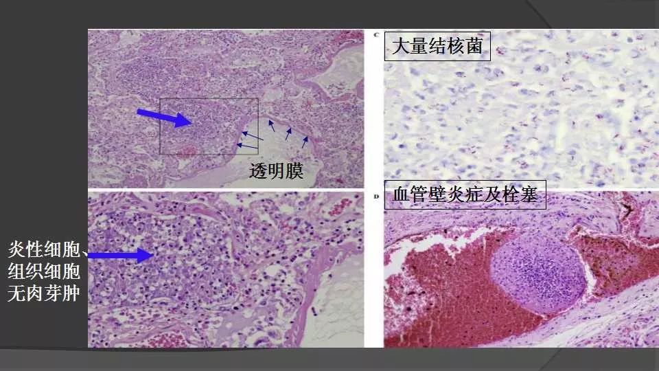 肺结核几种不典型影像模式的思考