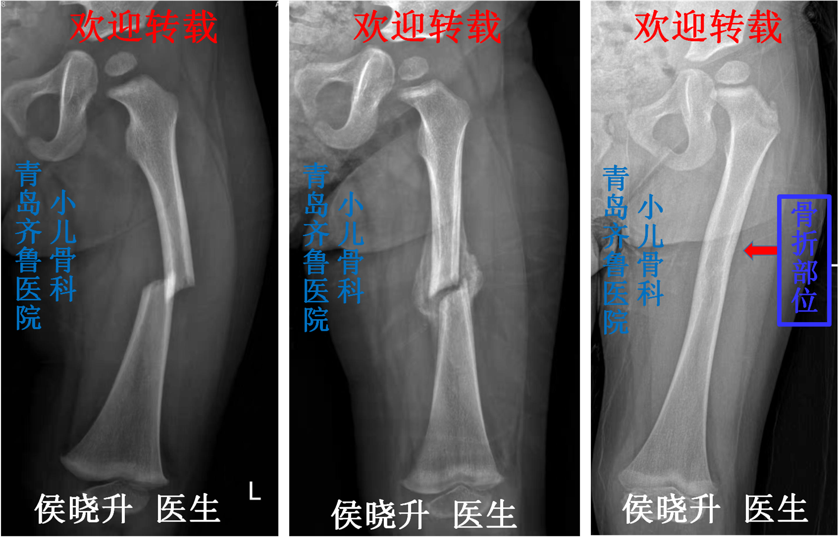 骨折后骨头生长过程图图片