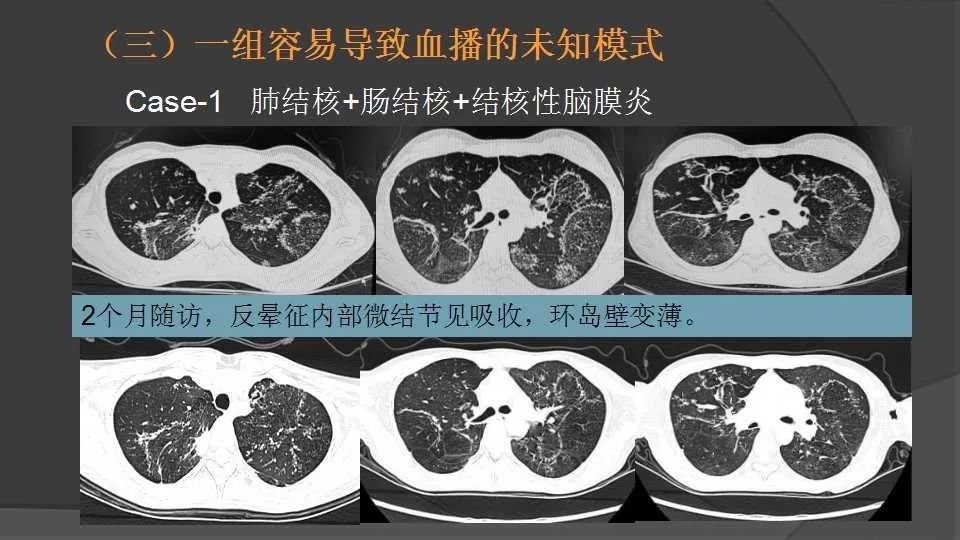 慢性血行播散型肺结核图片