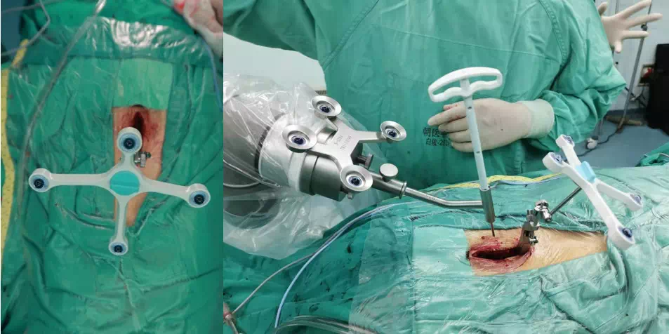 北京朝阳医院骨科完成首例天玑机器人辅助midlf微创手术