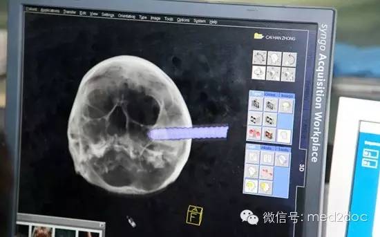 1岁孩头插入10cm钢针盘点那些史上最诡异的头颅影像片胆小者勿入