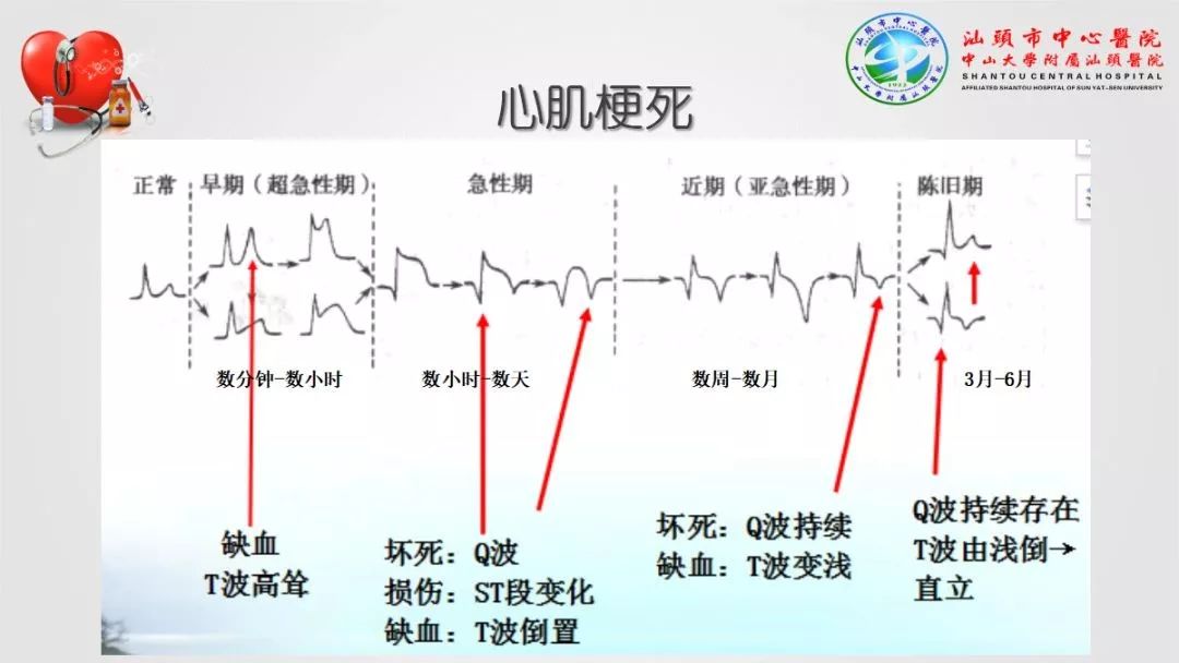 ppt心肌梗死心律失常异常心电图大盘点