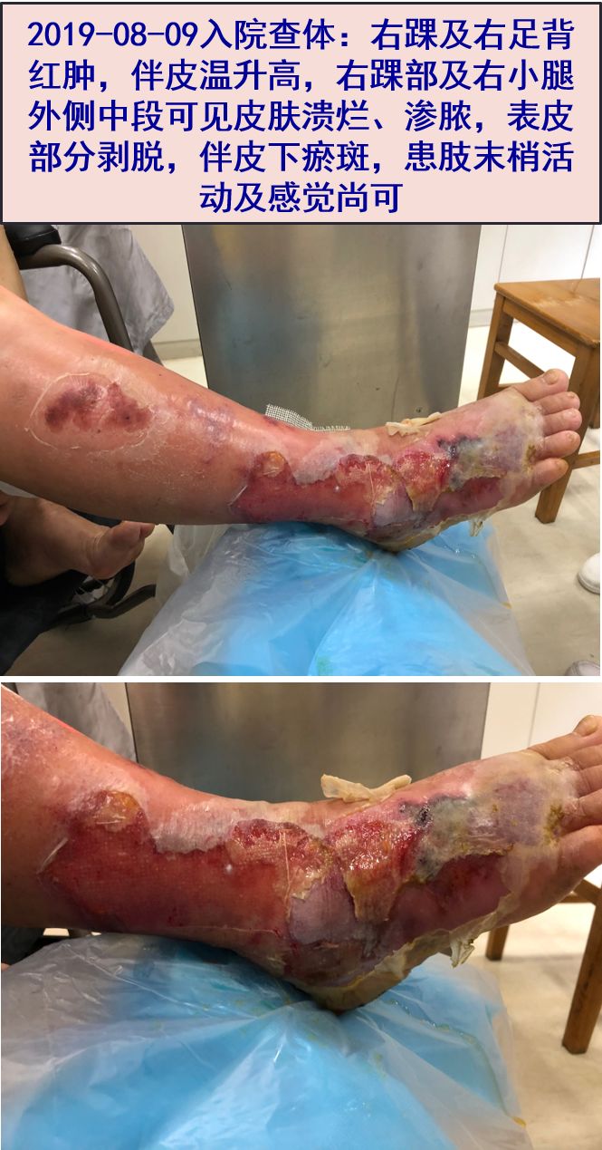 探案下肢皮肤大面积破溃渗脓抗生素治疗竟然无效