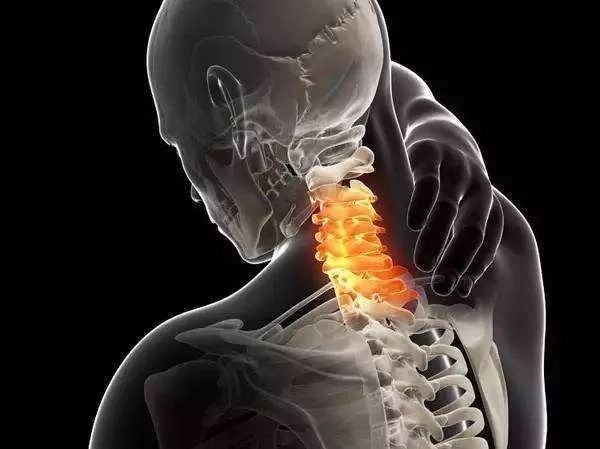 「 运动康复」颈椎失稳(cervical spine instability)