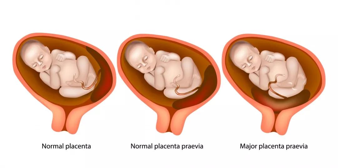 胎盤前置vs胎盤前壁,孕媽媽們可要分清哦!_子宮