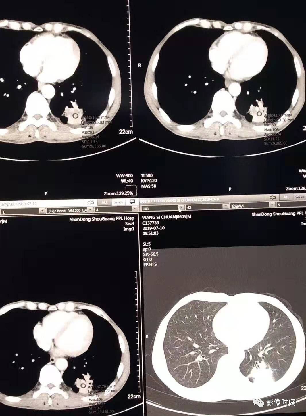 肺部病灶 | 炎症还是癌症,你可分得清?