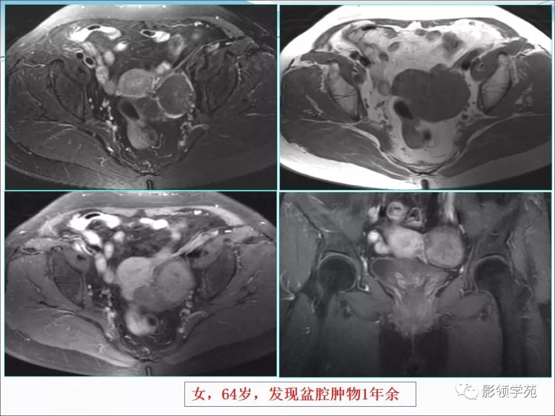 卵泡膜细胞瘤图片