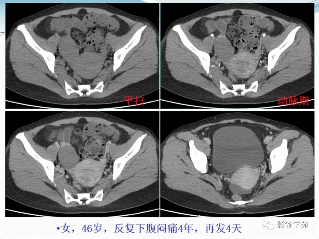 卵泡膜细胞瘤图片