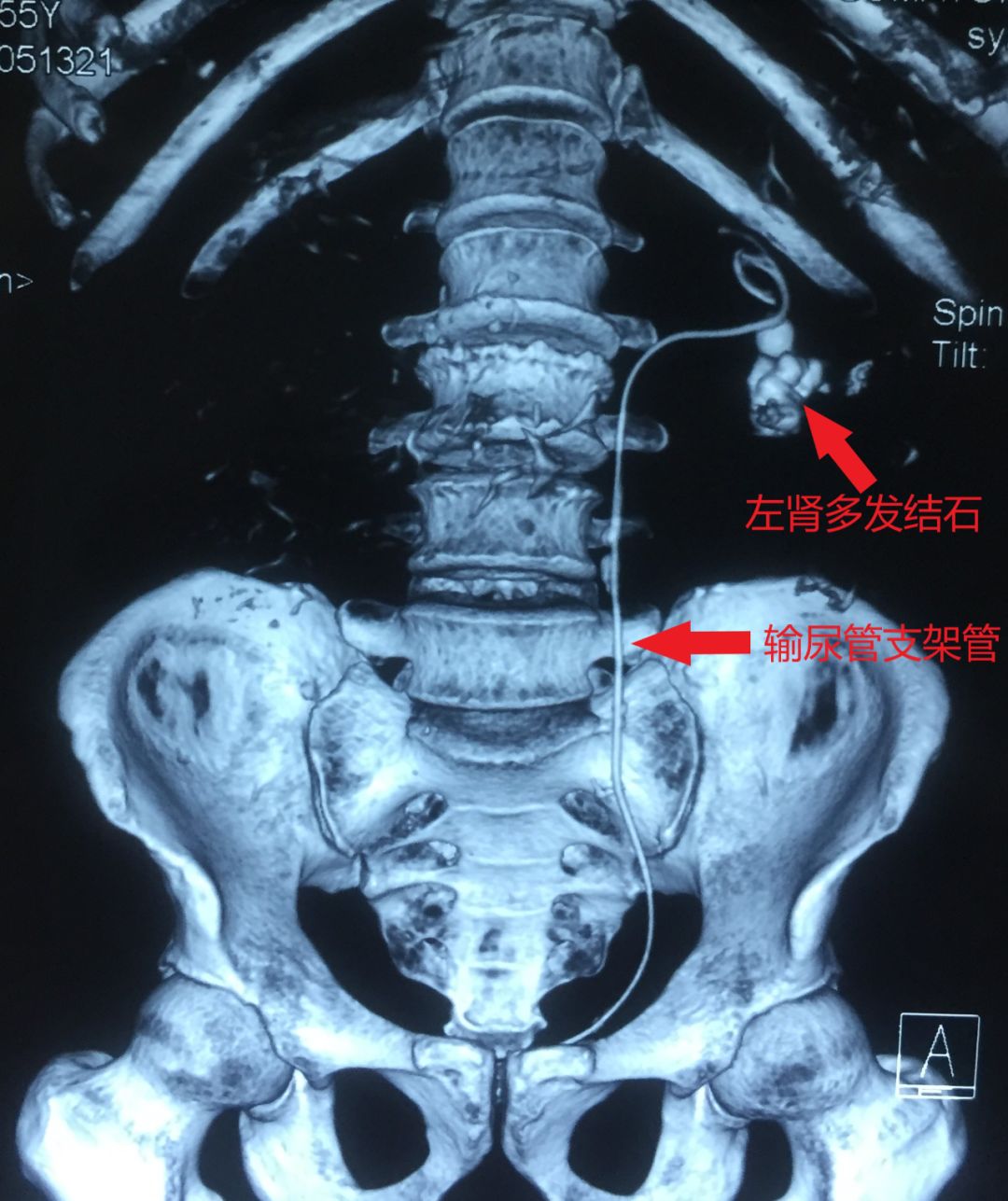 输尿管支架不良反应图片