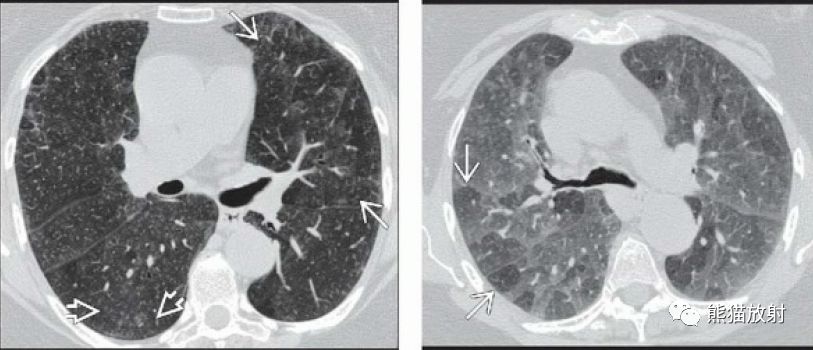 過敏性肺炎急性亞急性丨ct表現診斷要點