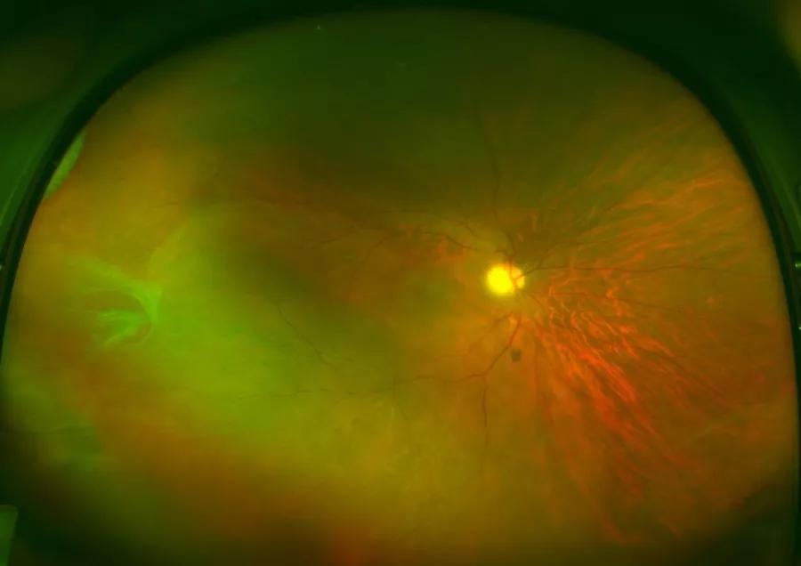 视网膜裂孔