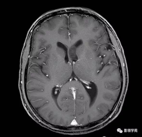 侧脑室内见类圆形稍长t1中等t2信号肿块室管膜下瘤