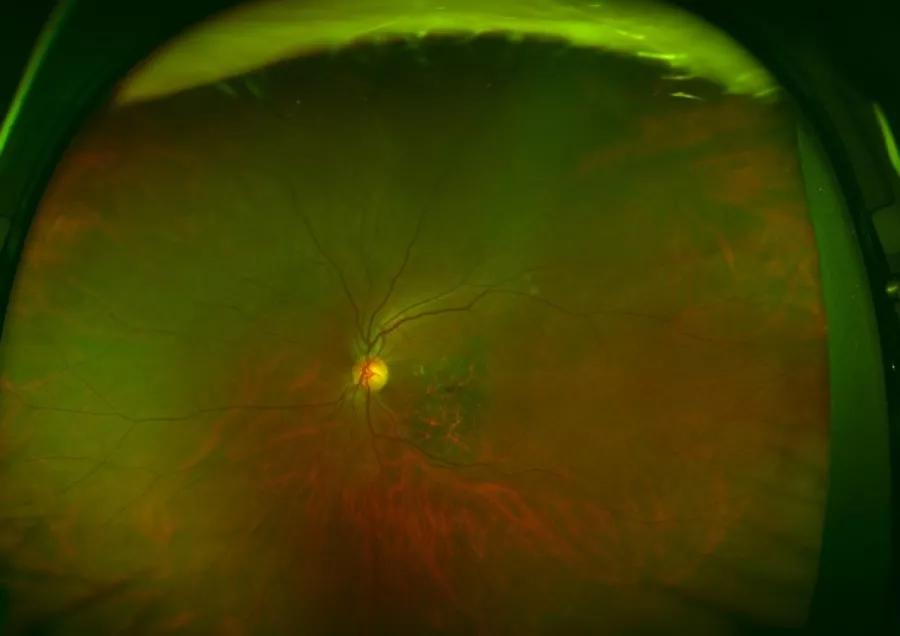 泉州眼科医院新设备引进:眼底世界,欧堡带你去看看