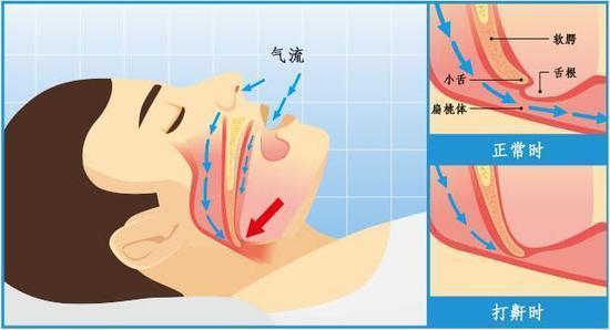 鼻窦炎,扁桃体炎,腺体肥大,舌体肥大等原因都可能导致上气道狭窄