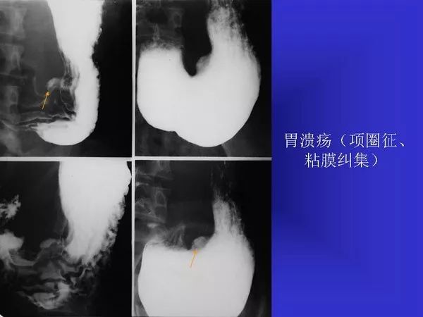 胃十二指肠溃疡与胃癌的影像学表现