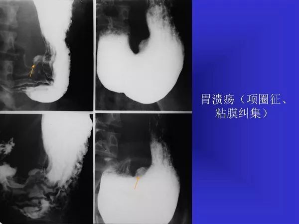 胃溃疡x线表现图片