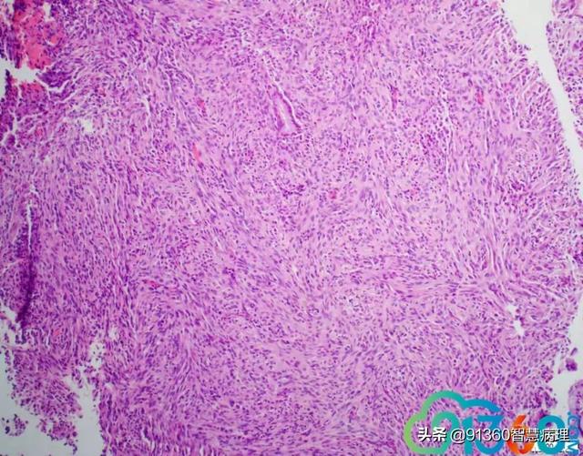 病理沙龙|宫颈:sarcomatoid carcinoma spindle cell carcinoma