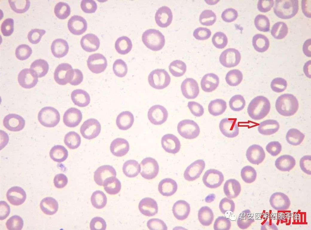 红细胞管型图片