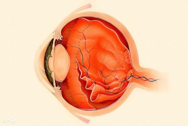 特別提醒:糖尿病患者要定期檢查眼底防範糖尿病眼病!_視網膜