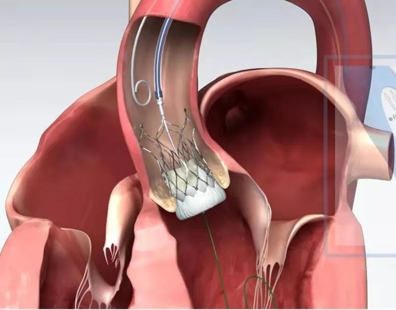 我院开展陕南首例经导管主动脉瓣植入